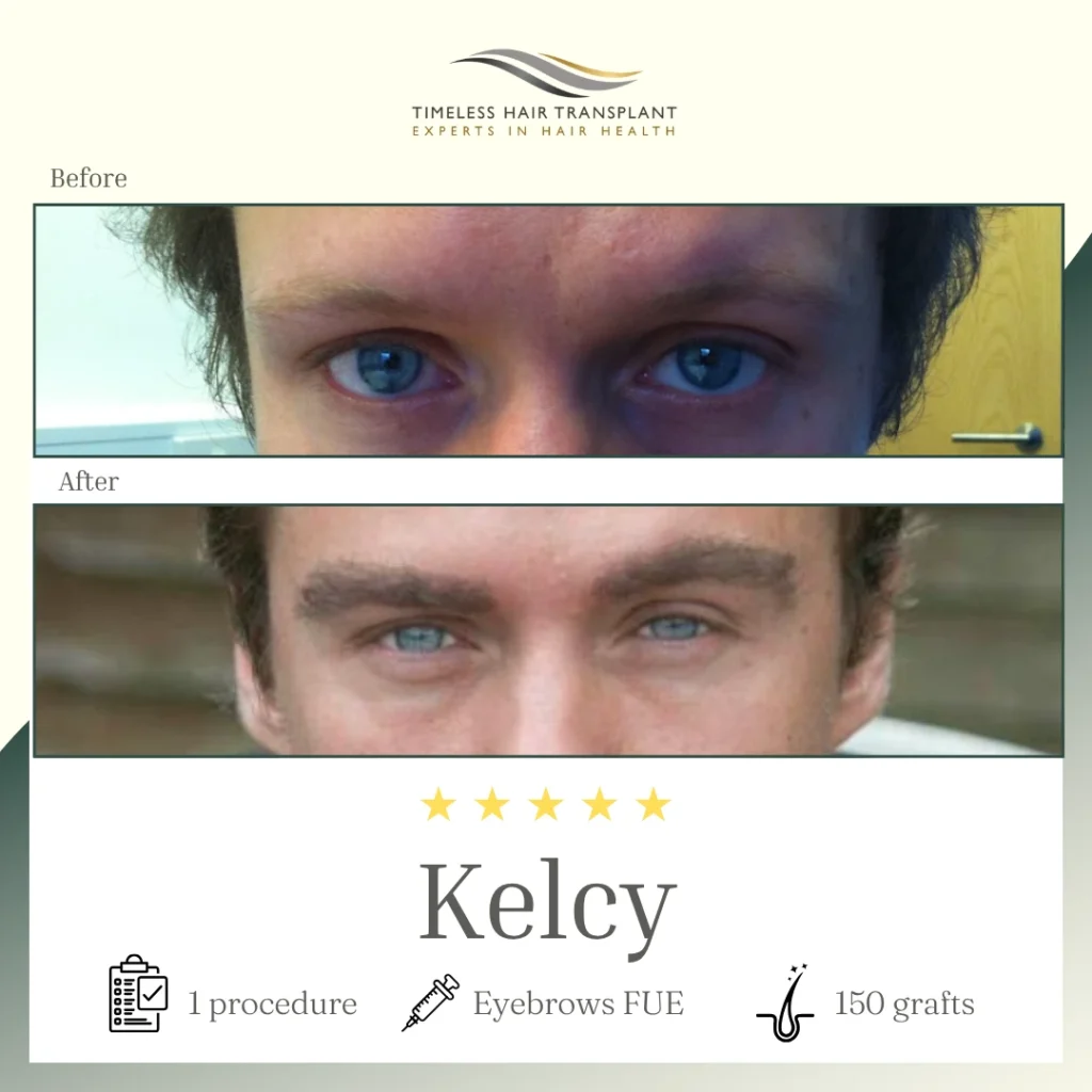 Eyebrows FUE -150 - Kelcy