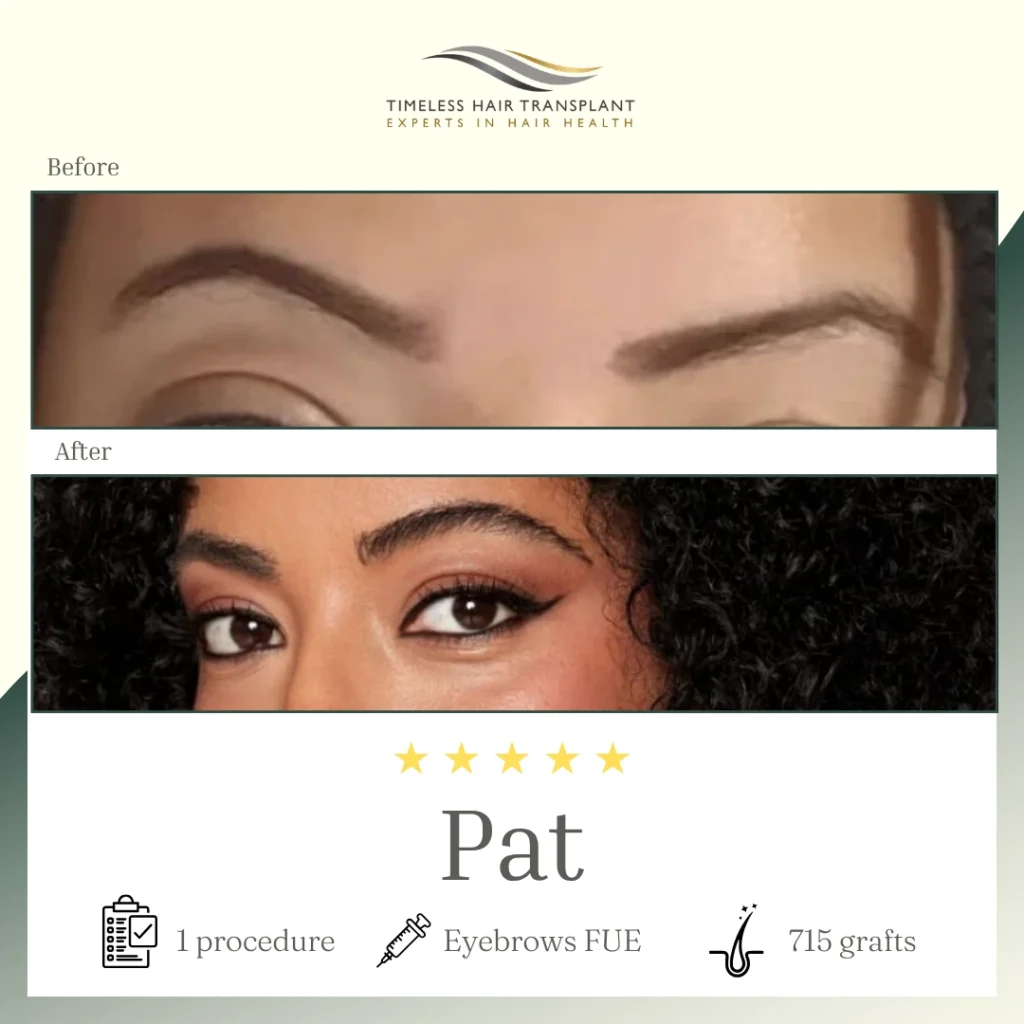 Eyebrows FUE 715 - Pat
