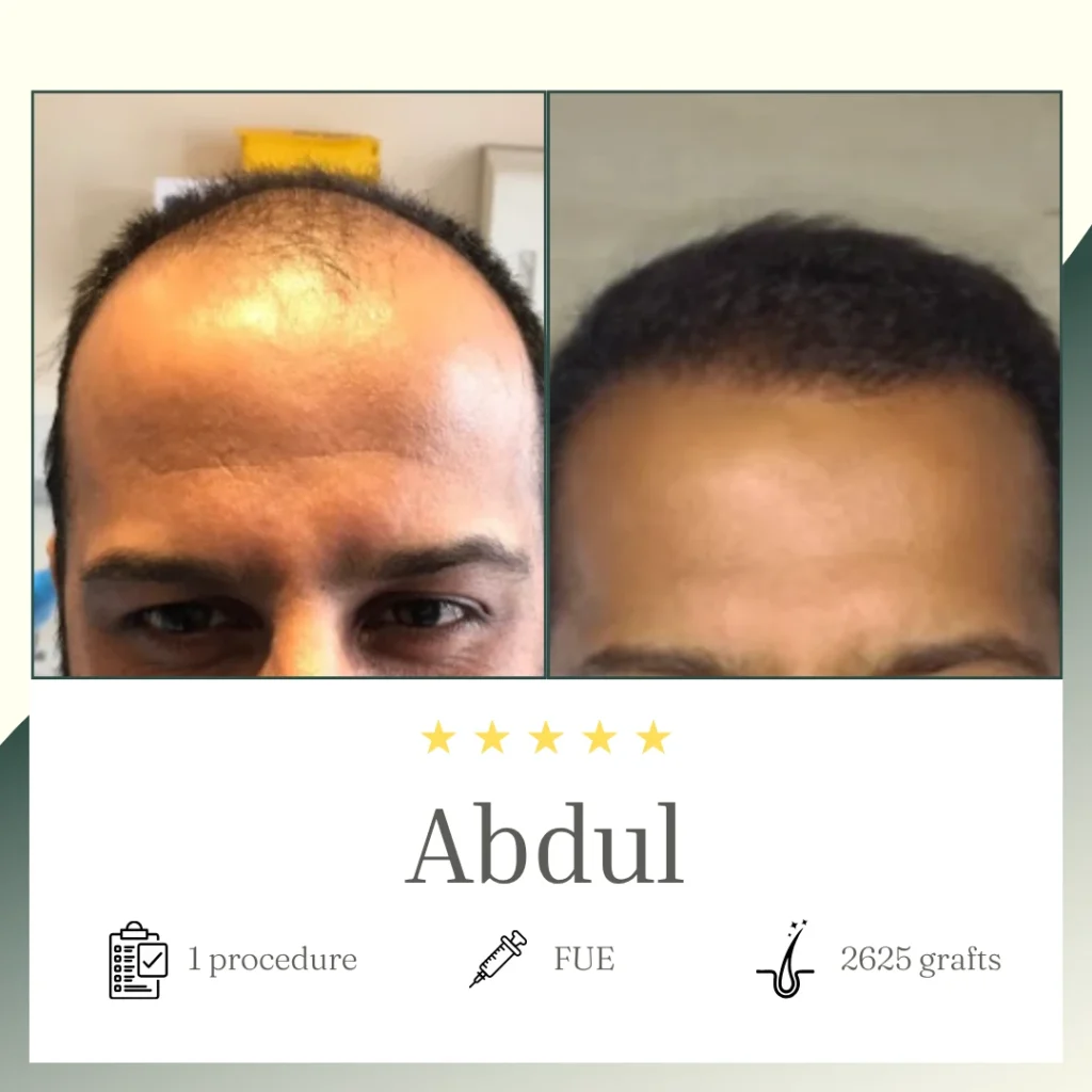 FUE 2625 - Abdul hair Transplant