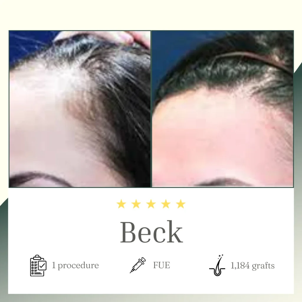 FUE Procedure - Beck