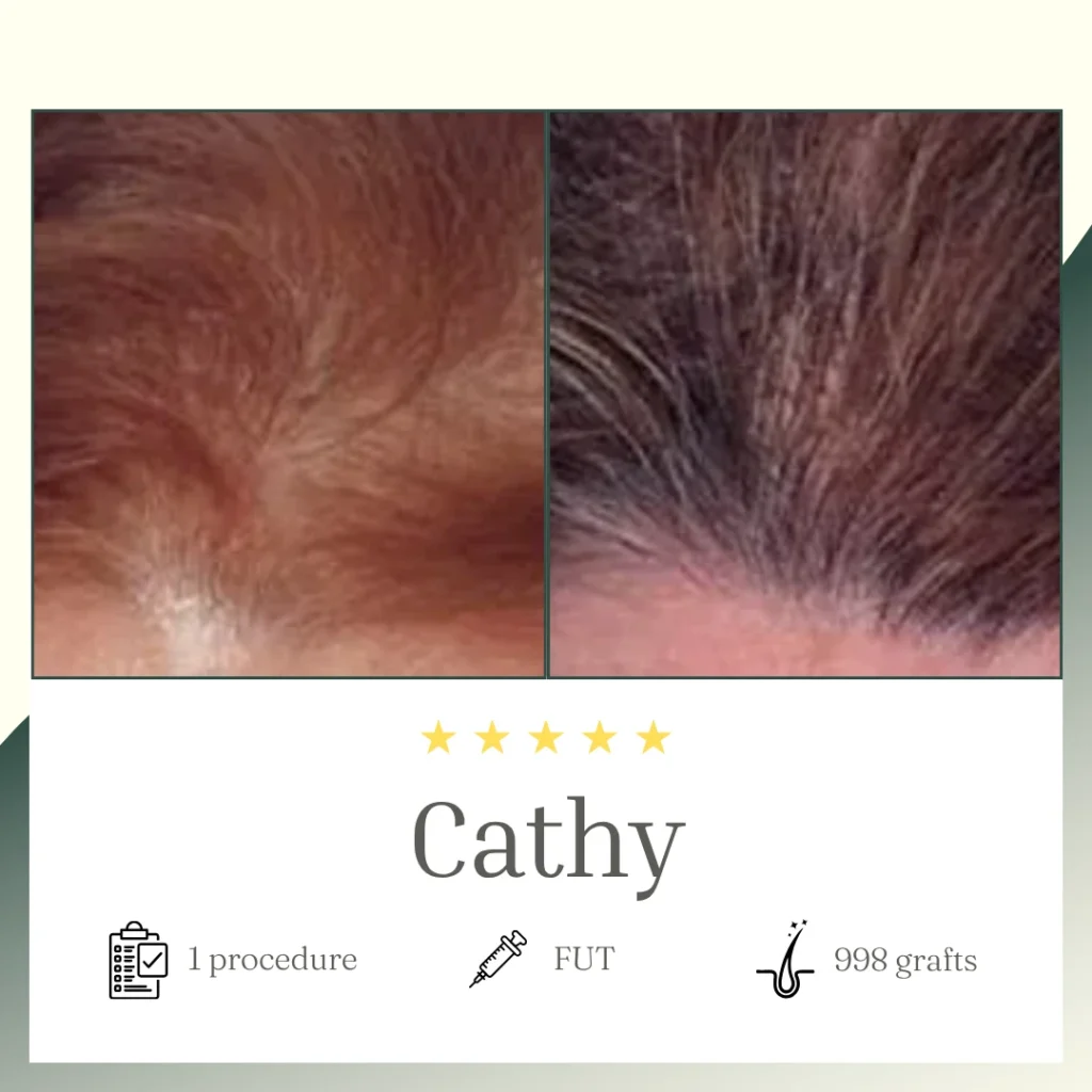 FUT Procedure - Cathy