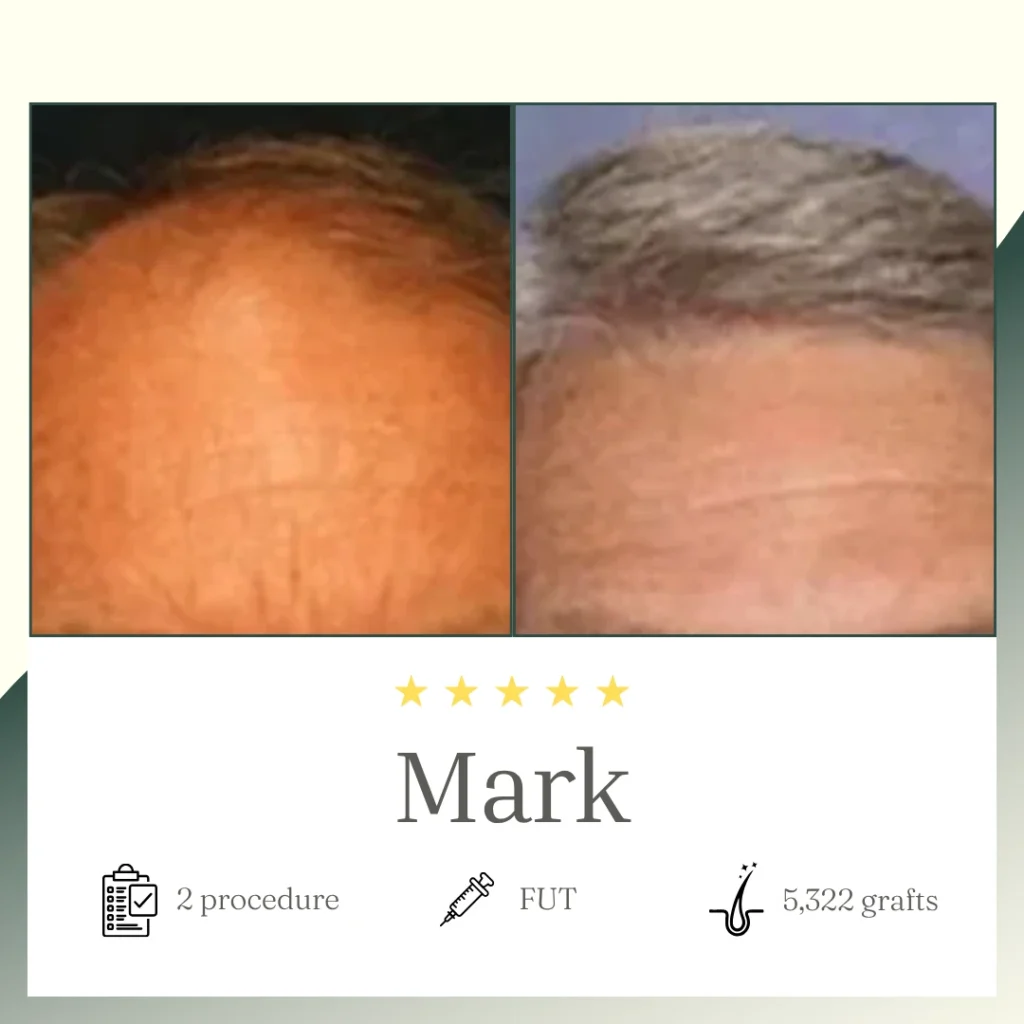 FUT Procedure - Mark