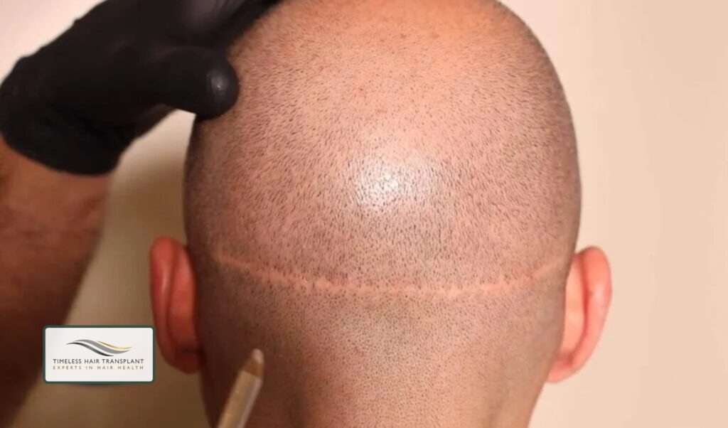 FUT Scar Revision