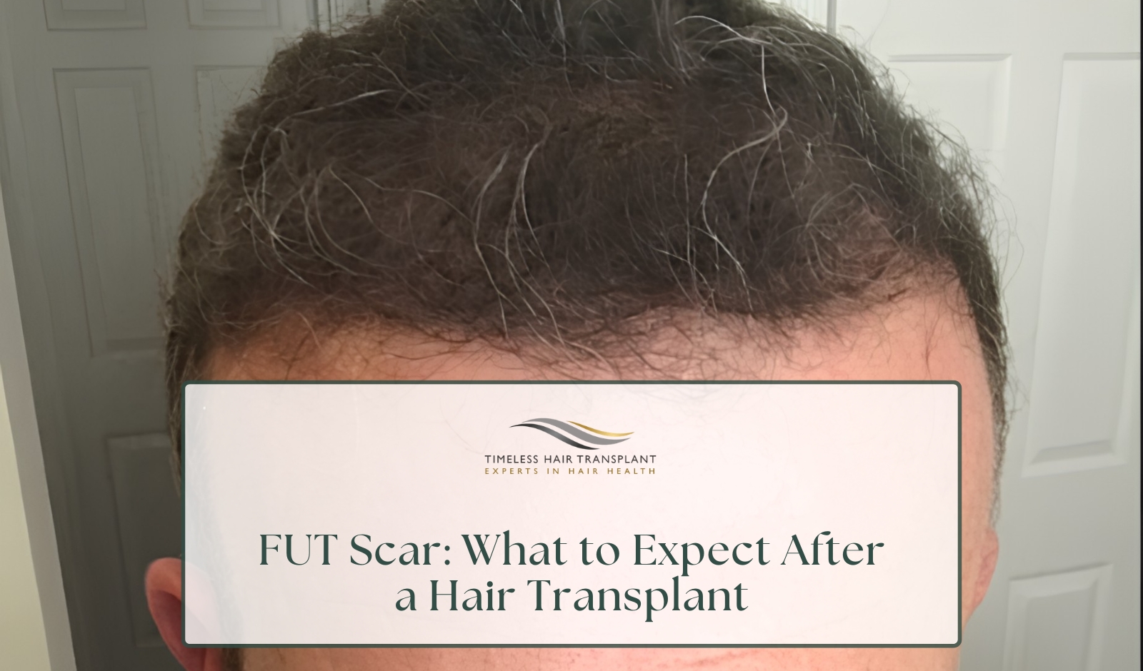 FUT Scar What to Expect After a Hair Transplant