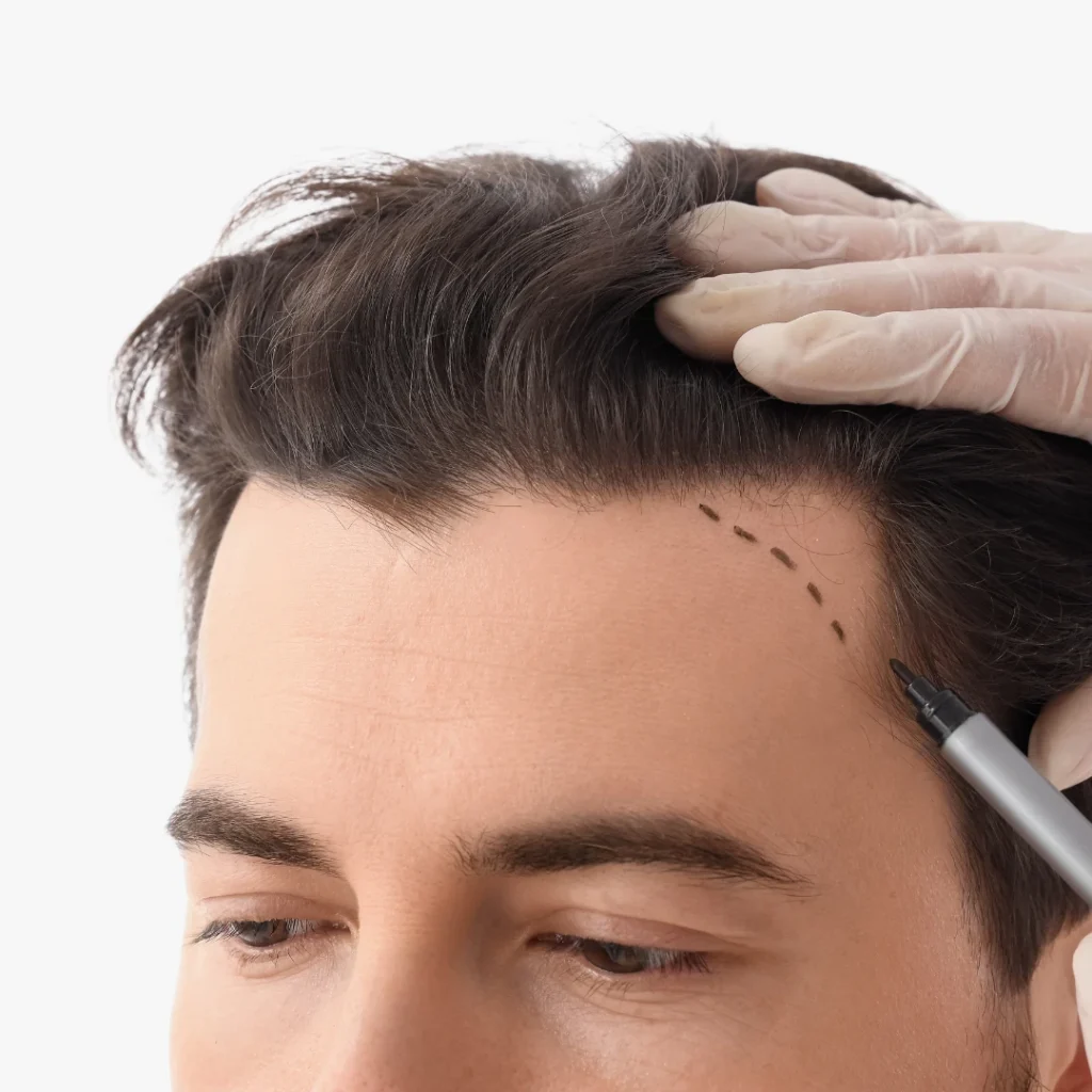 Hair Transplant Cost