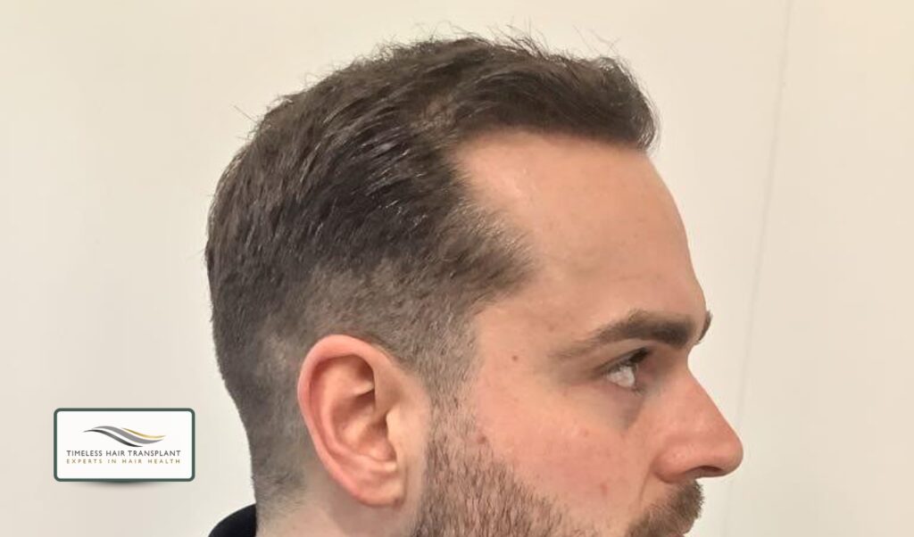 What Is a FUT Scar