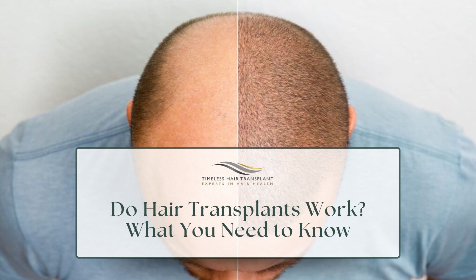 Do Hair Transplants Work_ What You Need to Know