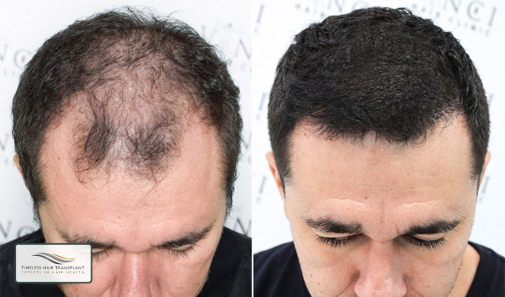 Does a Hair Transplant Work?