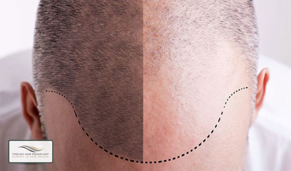 Does a Hair Transplant Hurt