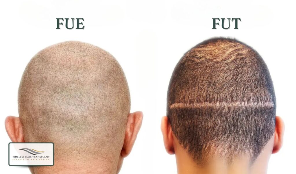 FUE or FUT Hair Transplant Which Is Better