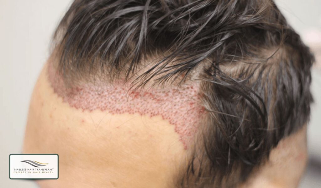Follicular Unit Transplantation (FUT)