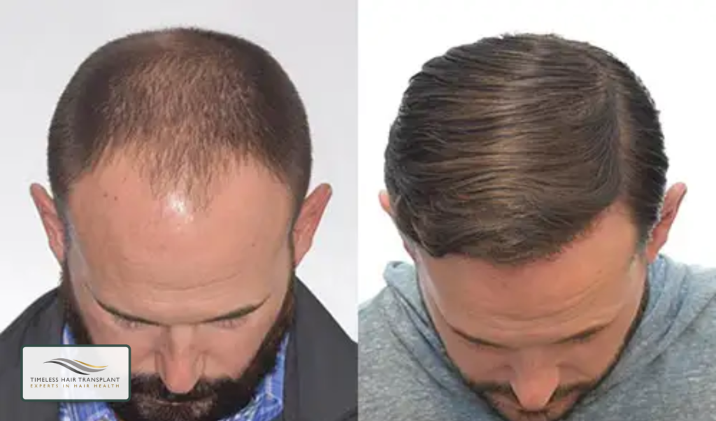 Hair Transplant Techniques_ FUE and FUT