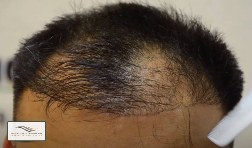 How Common Is Hair Transplant Failure