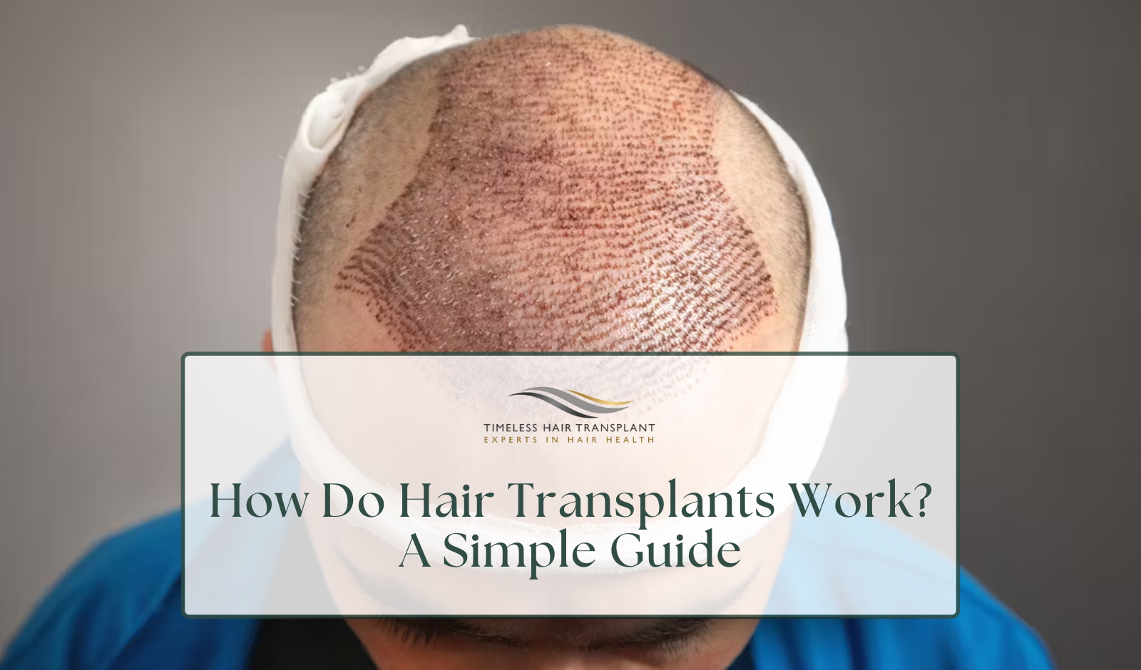 How Do Hair Transplants Work_ A Simple Guide