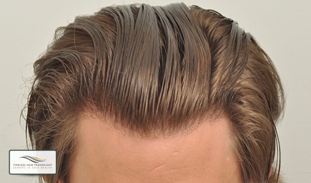 How Long Does Hair Transplant Last After Treatment