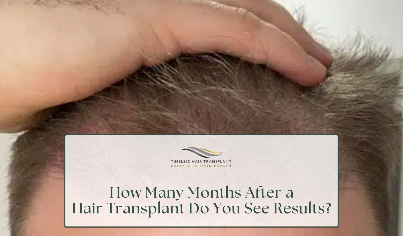 How Many Months After a Hair Transplant Do You See Results
