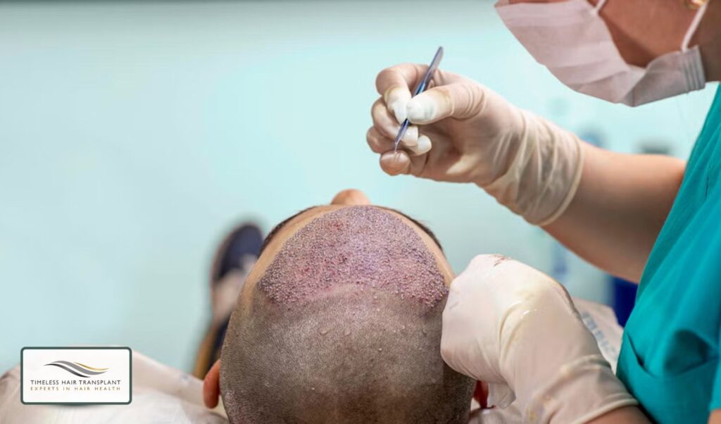 How Much Does Hair Transplant Surgery Cost in the UK