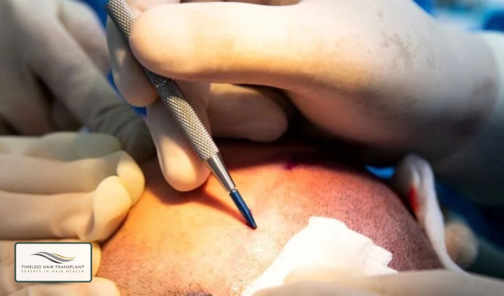 Is There Pain During the FUE Hair Transplant Procedure