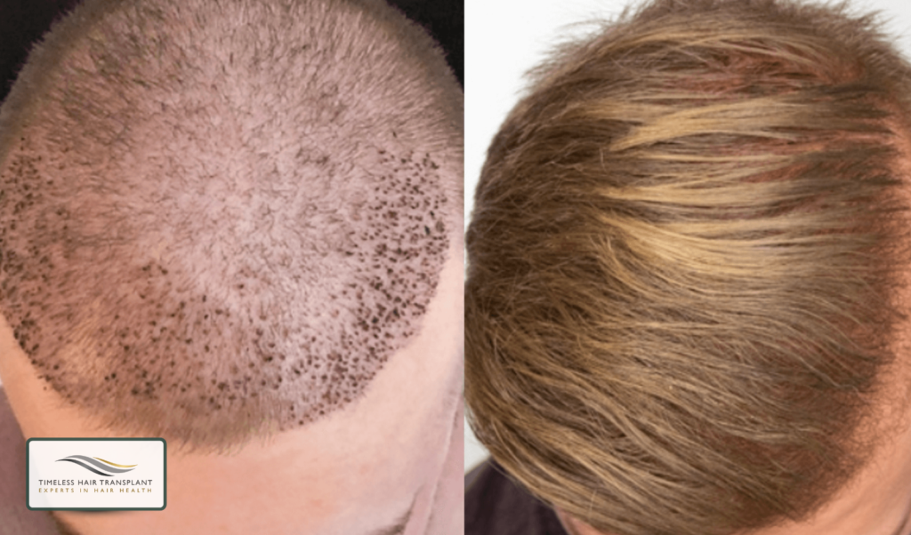 Recovery and Hair Growth Timeline