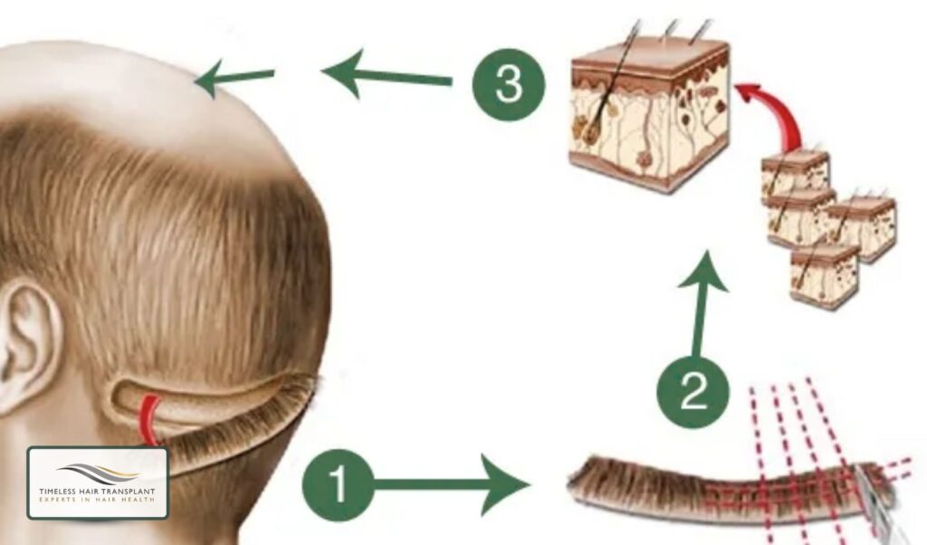 Understanding the FUT Hair Transplant Procedure