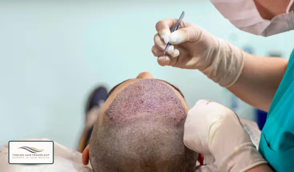 What Happens During a Hair Transplant