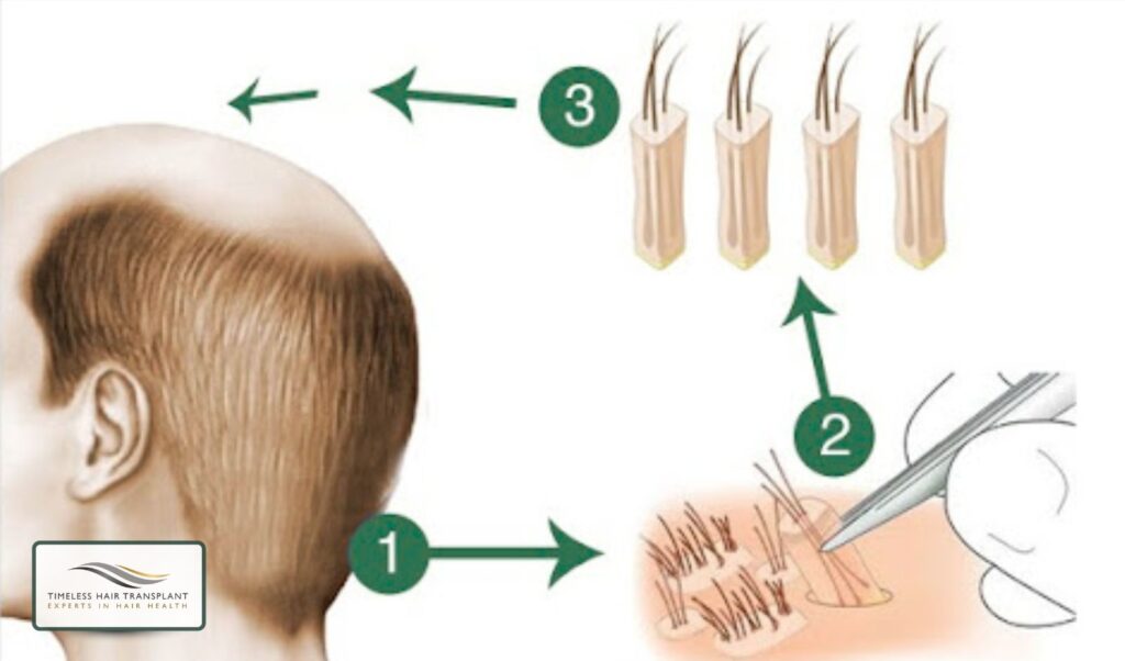 What Is FUE (Follicular Unit Extraction)