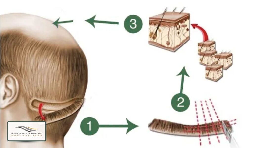 What Is FUT (Follicular Unit Transplantation)