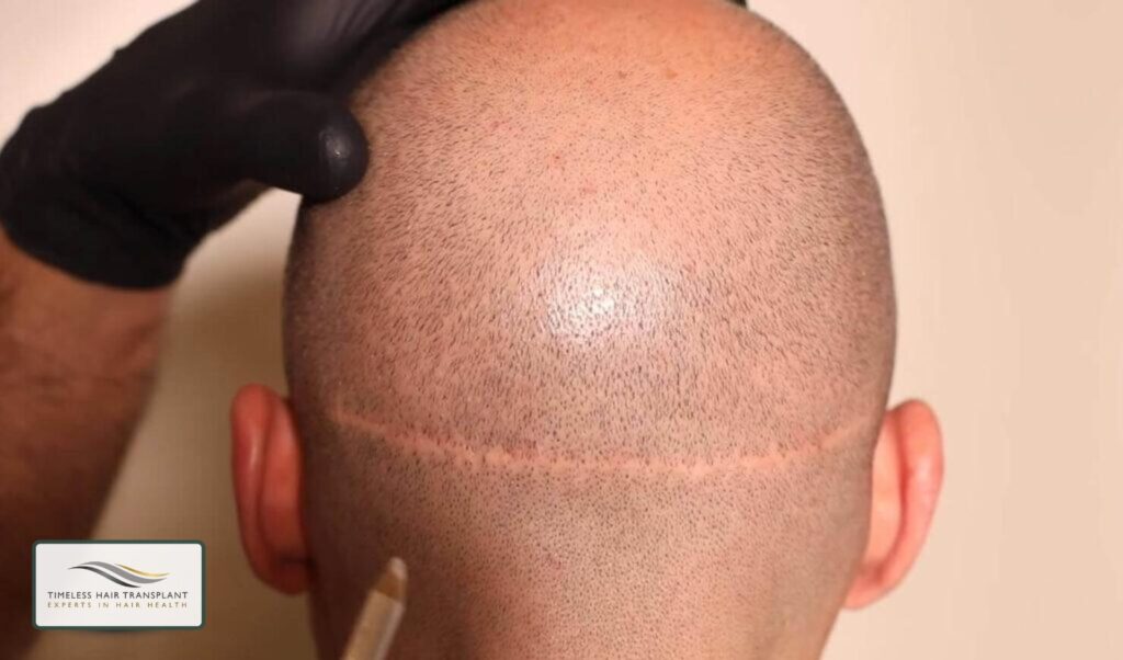 What Is FUT Hair Transplant