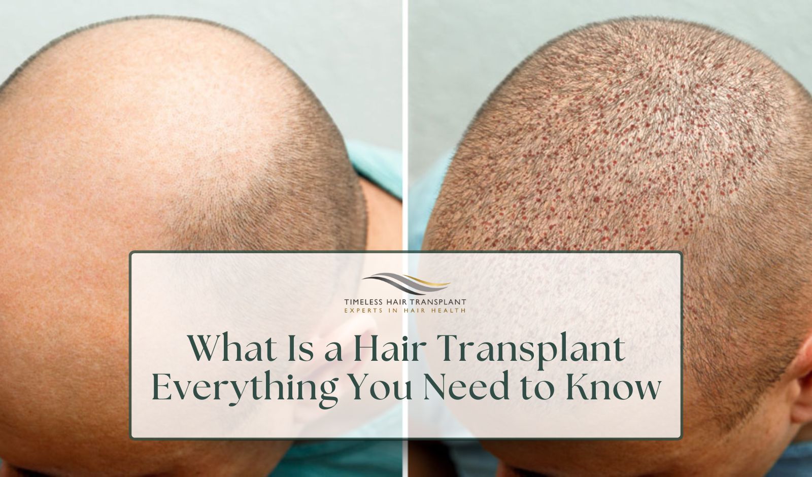 What Is a Hair Transplant Everything You Need to Know