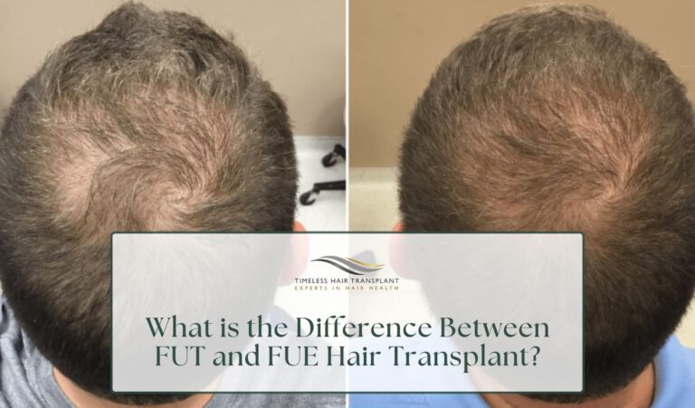 What is the Difference Between FUT and FUE Hair Transplant